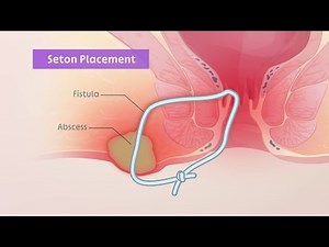 Seton placement for perianal fistulas | TVASurg