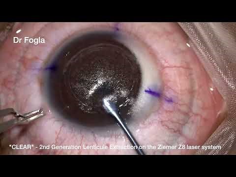 "CLEAR" second generation KLEX / lenticule extraction on Ziemer Z8