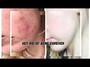 5 DIY Acne Face Masks That Actually Work!