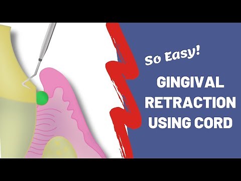 Gingival Retraction using Cords | The Easy Way!