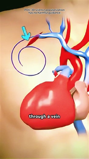 How Pacemaker Insertion Procedure Is Performed (3D Animation)