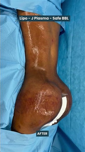 Sculpt your dream look with Liposuction and Safe BBL #safebbl #bblpostop #beforeandafter #beauty