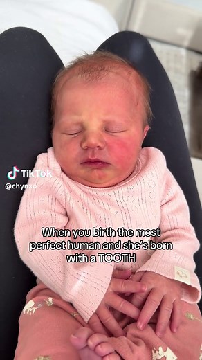 Baby Born With Natal Tooth: What to Know