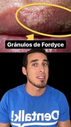 Do you have these SPOTS on your LIPS or GENITALS? Here I explain what it is - Fordyce