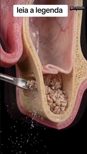 Maxillary sinus lift: the detail that can compromise your entire case.