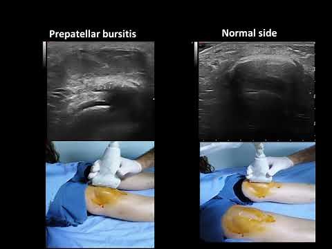 Ultrasound guided prepatellar bursitis injection (Housemaids knee)