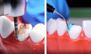 Cómo se restauran los dientes 🦷 Los dentistas hacen magia (con audio 🔊): | Ideas en 5 minutos