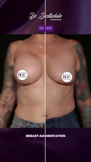 Breast Augmentation Mastopexy | Before & After & Recovery
