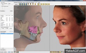 3D Visual Treatment Objective (VTO) Software Demo on Make a GIF
