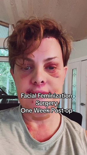 I just had facial feminization surgery last week. as a transgender woman this feels like a pretty big deal and i wanted to talk about it 🏳️‍⚧️ #trans #transition #ffs #facialfeminization