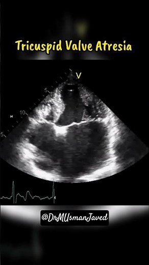 Tricuspid Valve Atresia