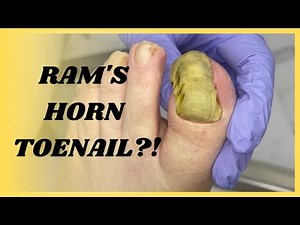 Trimming THICK "Ram's Horn" Toenail