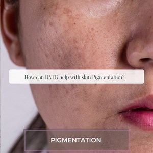 Let's talk about Pigmentation // Pigmentation literally means coloring. Your skin gets its colour from a pigment called melanin. Special cells within the skin make your melanin. When these cells become damaged or unhealthy, it affects their melanin production: If your body makes too much melanin, your skin gets darker. Some pigmentation disorders affect just patches of skin whereas others affect your entire body. Hyperpigmentation is a broad term that covers any excessively pigmentated (brown / 