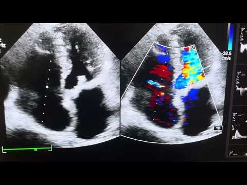 Bio prosthetic mitral valve in Echo views #echo #heart