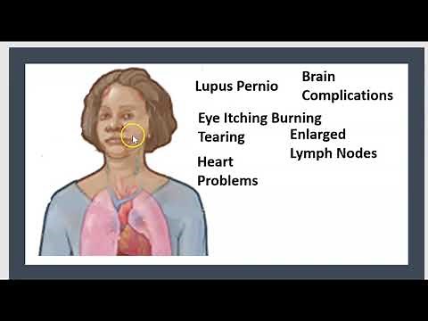 2-Minute: Bell's Palsy/ Facial/ Causes/ Symptoms/ Treatment/ Rehabilitation/ Peripheral/