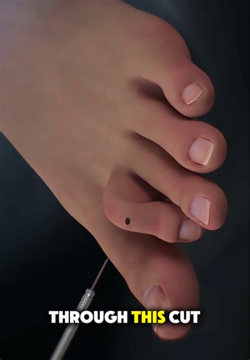 hammer toe repair surgery #3dmedicalanimation #footsurgery #podiatry #hammertoesurgery #hammertoerepair