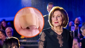 What happened to Nancy Pelosi's nose?