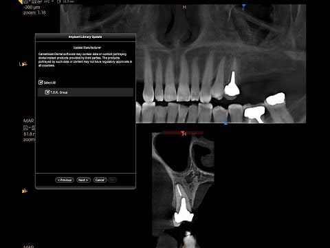CS 3D Imaging - Updating Implant Library