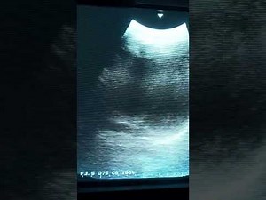 Female heart, breathplay, ultrasonic device, heartbeat sound