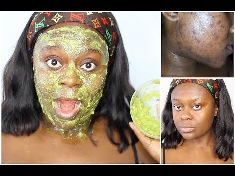 REMOVE DARK SPOTS, TIGHTEN SKIN & PREVENT ACNE USING THIS FACE MASK | DIY AVOCADO FACE MASK