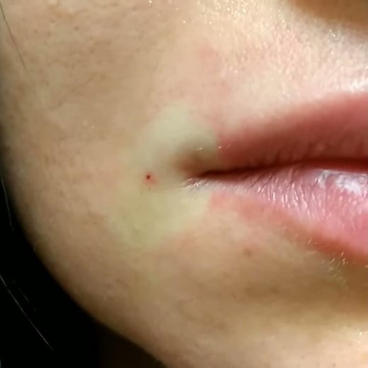 Lip injection! Blunt Cannula Technique, No pain or brusing. Immediate RESULTS by Dr. Lebowitz