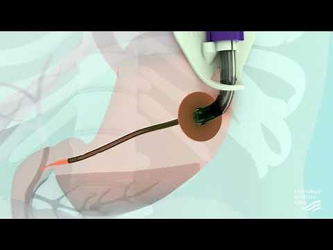 PEG-J sonde - Ziekenhuis Gelderse Vallei
