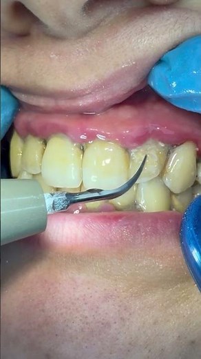 The Sound of Clean | Professional Teeth Scaling ASMR