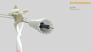 Mini-Open Latarjet using DOUBLE ENDOBUTTON Fixation Animation