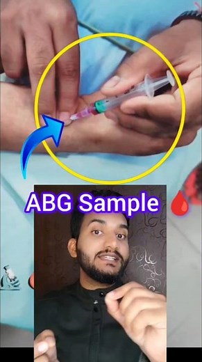 ABG blood Sampling
