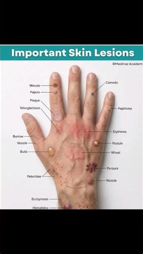 TYPE OF SKIN LESIONS || ICD 10 PCS AND ICD 10 CM #ccs #exam #cpc #education #science #medicalbilling