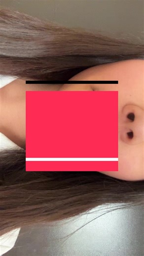 Tipos de brackets y colores en el tratamiento orthodontico