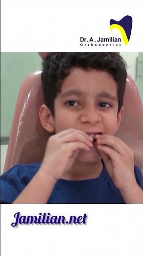 Functional Appliance for treating Small Lower Jaw#dentist #functional #orthodontics #Small_lower_jaw