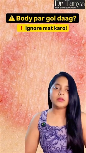 Seeing a circular rash on your skin? ⚠️It might be Ringworm (Tinea Corporis)