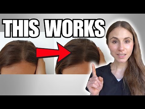 Affordable Hair Growth Treatment That WORKS | Minoxidil Pills