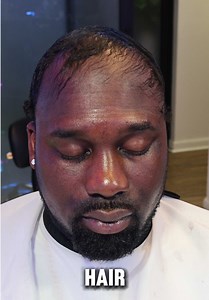 Hairline Rescue: Big Chop Transformation Reveal