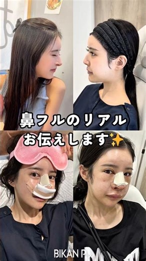 I'll tell you the truth about a full nose ✨ #Rhinoplasty #Beauty #CosmeticSurgery #Dr.Park #Plast...