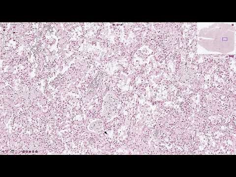 Pneumocystis Jirovecii Pneumonia - Histopathology
