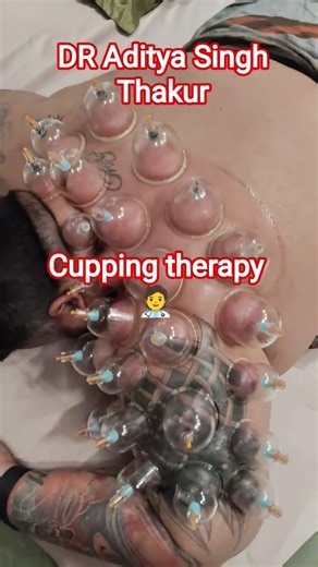 cupping therapy Dr Aditya Singh 🧑‍⚕️
