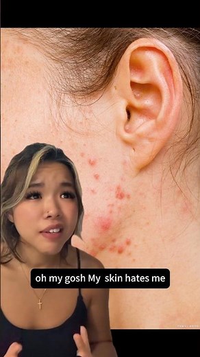 What happens during a cold plasma facial?😍#coldplasma #skincare #skinsafe