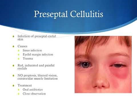 External Causes of Red Eye