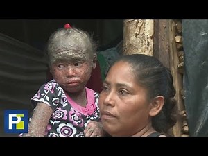 This girl lives with scaly skin due to a strange disease.