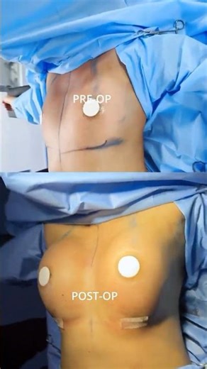 Breast Augmentation Transformation | Natural Shape & Symmetry Pre OP And Post OP