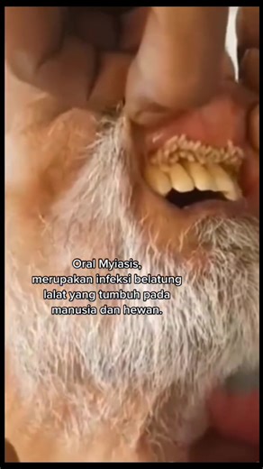 #stitch with @Neyzar Albar Oral myiasis adalah kondisi medis yang jarang terjadi, di mana larva lalat menginfeksi jaringan lunak di dalam rongga mulut. Hal ini dapat terjadi ketika lalat bertelur pada jaringan yang lembab atau terluka di dalam rongga mulut, seperti pada gigi berlubang, karies gigi, sisa makanan yang terperangkap di dalam gigi, atau luka pada gusi. Larva yang menetas kemudian mulai memakan jaringan lunak di sekitarnya, yang dapat menyebabkan gejala seperti rasa sakit, peradangan,