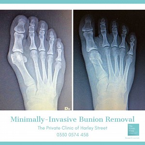 Bunion removal doesn't have to be invasive, chronically painful or...