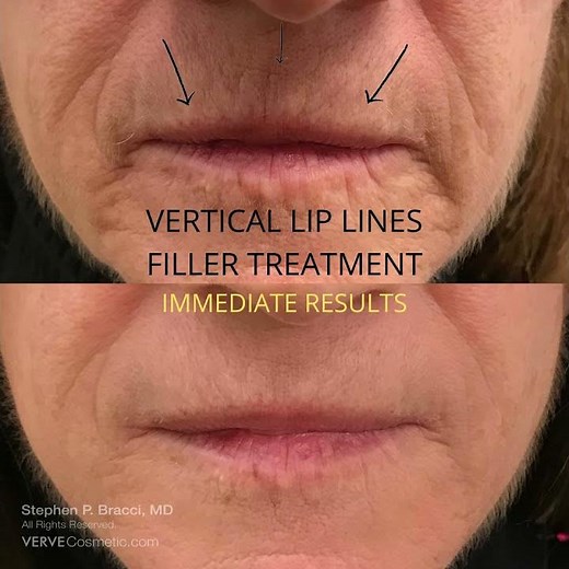 Vertical lip line wrinkles removal
