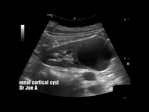 Renal cortical cyst left kidney ultrasound video