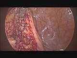 Laparoscopic Sigmoid Colectomy For Diverticulitis - Sparing IMA • Video • MEDtube.net