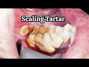 The Giant Tartar Removal Method That Brings Instant Relief #071