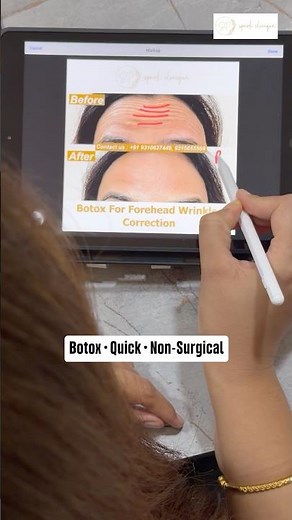 Forehead Wrinkles Treated with Botox ✨ | Real Results Reveal