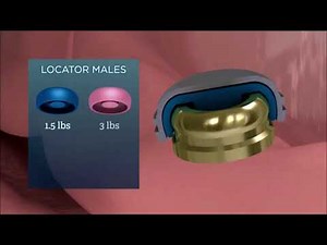 Zest Locators All Inclusive Overdenture Attachment System